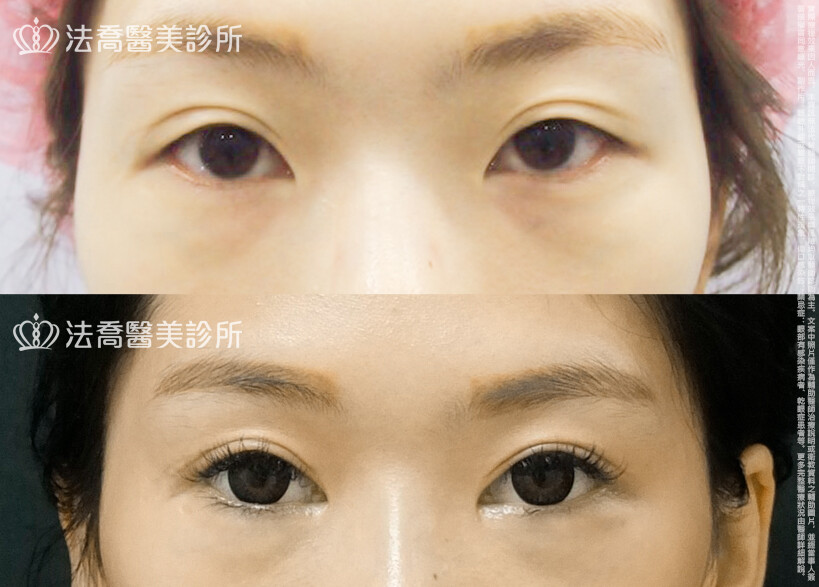 法喬醫美診所,邱浚彥,割雙眼皮,眼瞼肌提拉術,開眼頭,開眼尾