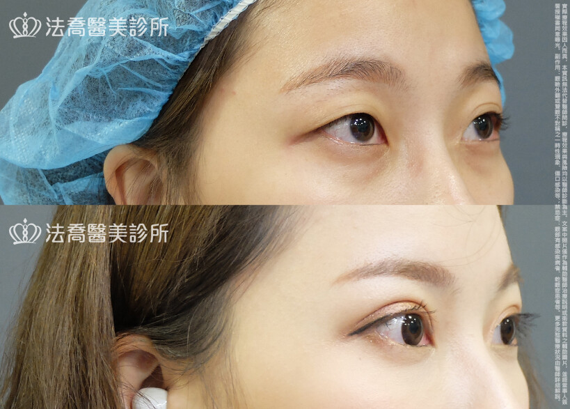 法喬醫美診所,邱浚彥,割雙眼皮,眼瞼肌提拉術