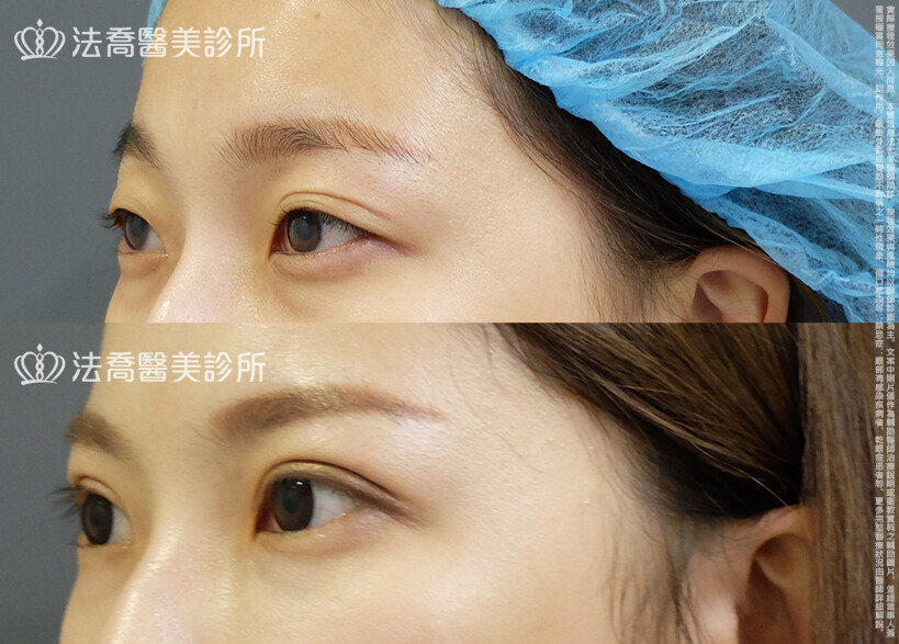 法喬醫美診所,邱浚彥,割雙眼皮,眼瞼肌提拉術