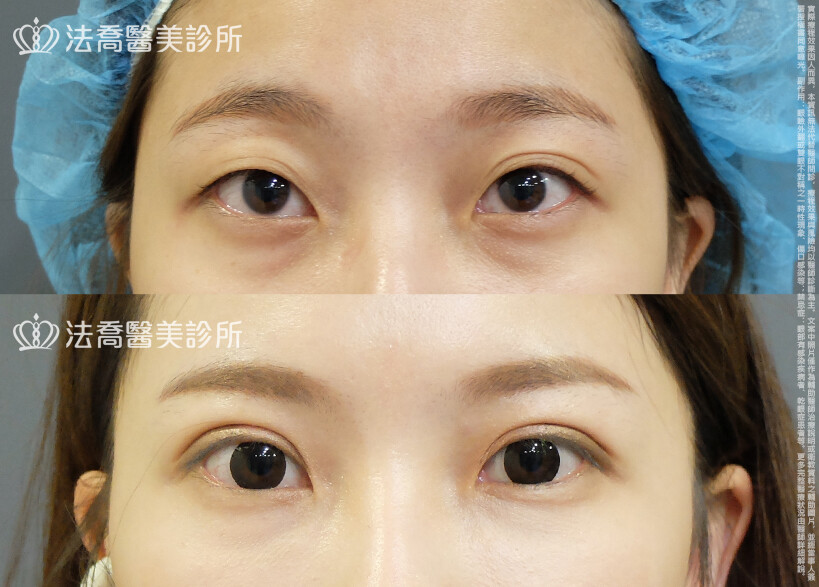 法喬醫美診所,邱浚彥,割雙眼皮,眼瞼肌提拉術