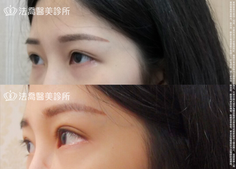 法喬醫美診所,邱浚彥,割雙眼皮,眼瞼肌提拉術,開眼頭,開眼尾