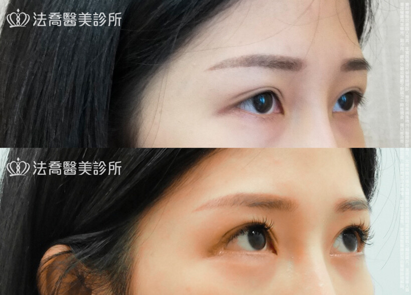 法喬醫美診所,邱浚彥,割雙眼皮,眼瞼肌提拉術,開眼頭,開眼尾