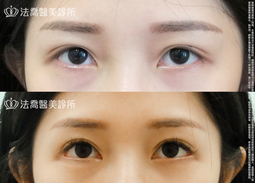 法喬醫美診所,邱浚彥,割雙眼皮,眼瞼肌提拉術,開眼頭,開眼尾