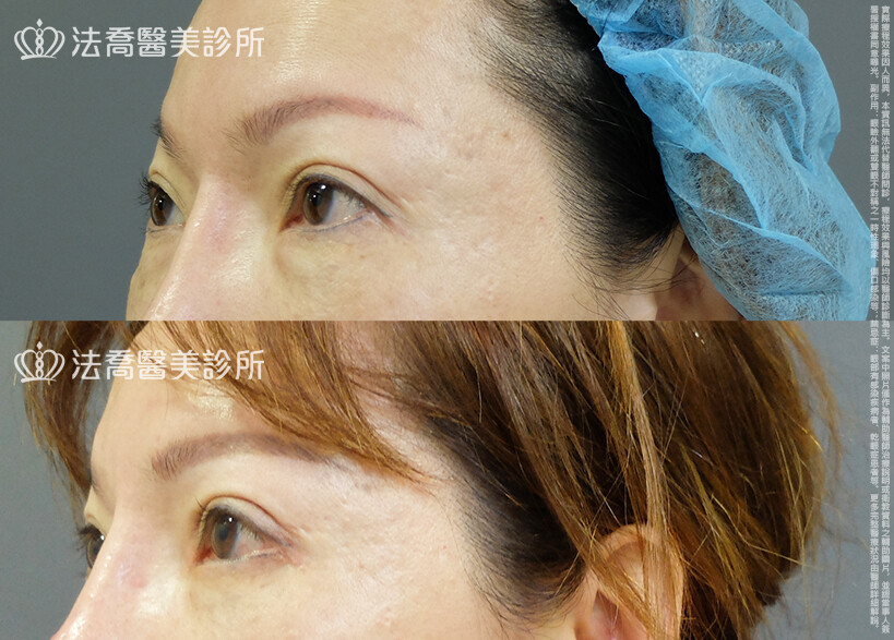 法喬醫美診所,邱浚彥,割雙眼皮,眼瞼肌提拉術