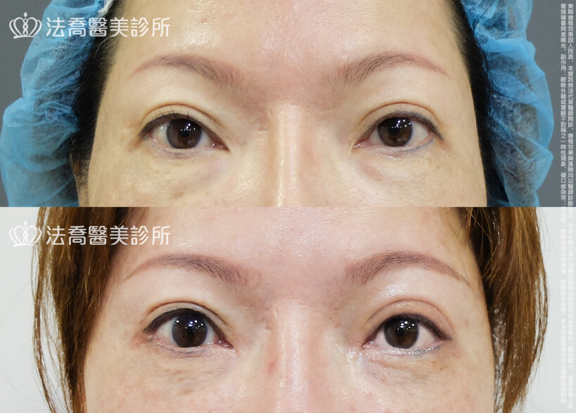 法喬醫美診所,邱浚彥,割雙眼皮,眼瞼肌提拉術