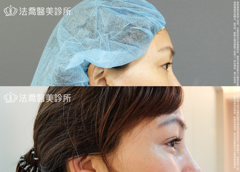 法喬醫美診所,邱浚彥,割雙眼皮,眼瞼肌提拉術