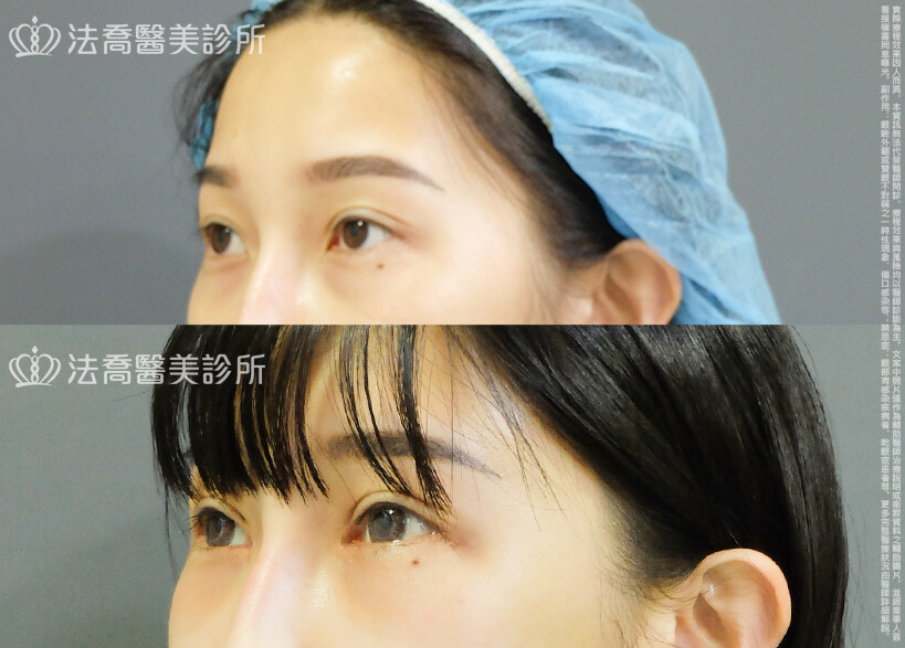 法喬醫美診所 邱浚彥醫師,割雙眼皮,眼瞼肌提拉術,開眼頭,開眼尾
