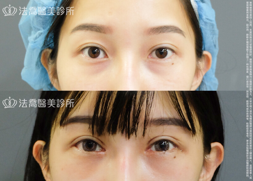 法喬醫美診所 邱浚彥醫師,割雙眼皮,眼瞼肌提拉術,開眼頭,開眼尾
