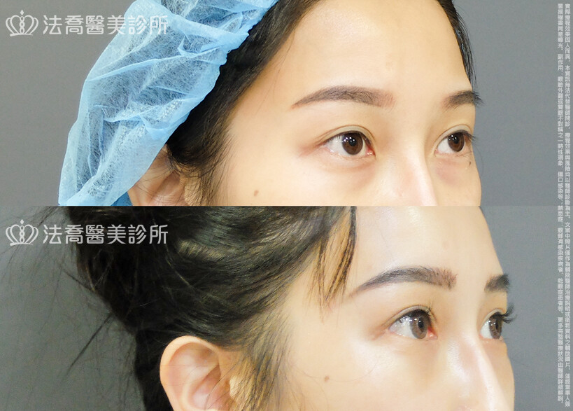 法喬醫美診所 邱浚彥醫師,割雙眼皮,眼瞼肌提拉術,開眼頭,開眼尾