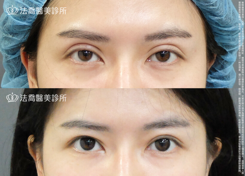 法喬醫美診所,邱浚彥,割雙眼皮,眼瞼肌提拉術