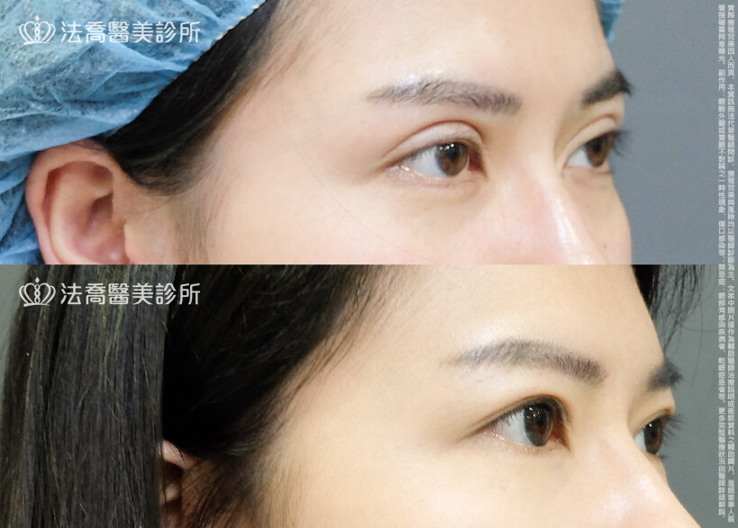 法喬醫美診所,邱浚彥,割雙眼皮,眼瞼肌提拉術