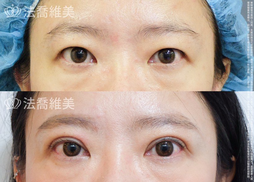 法喬醫美診所,邱浚彥,割雙眼皮
