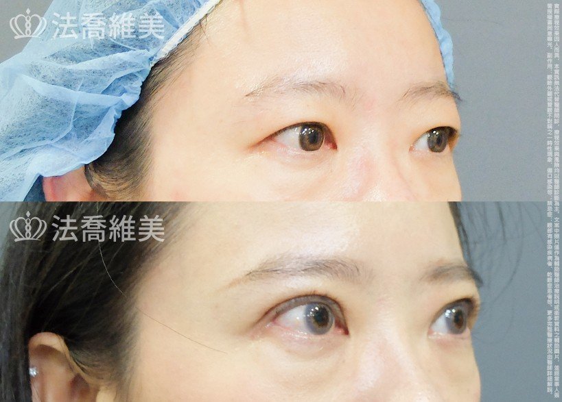 法喬醫美診所,邱浚彥,割雙眼皮