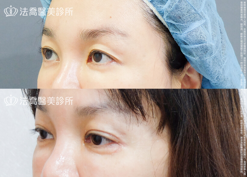 法喬醫美診所,邱浚彥,割雙眼皮