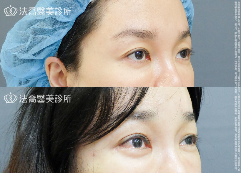 法喬醫美診所,邱浚彥,割雙眼皮