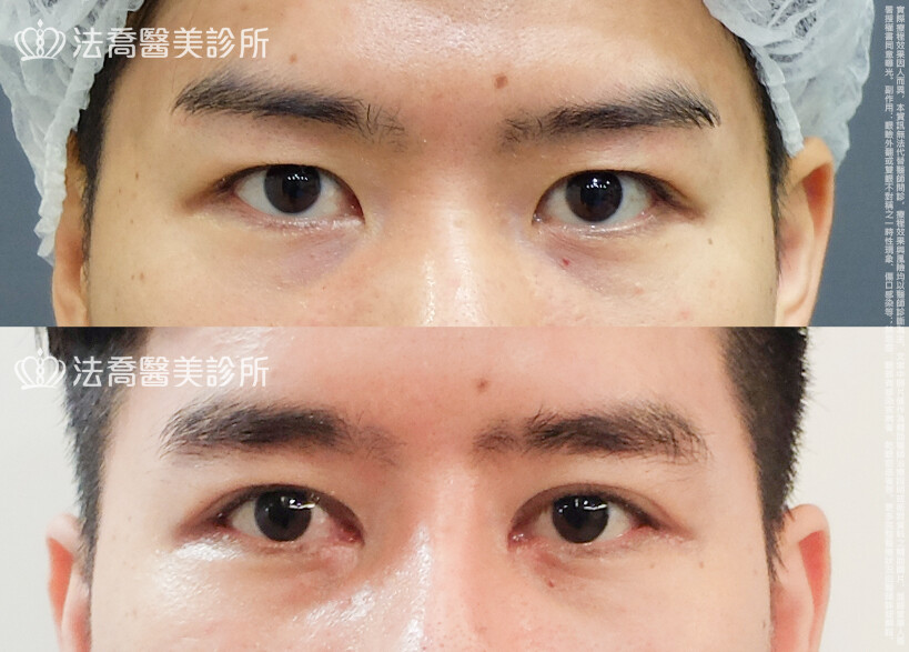 法喬醫美診所,邱浚彥,割雙眼皮