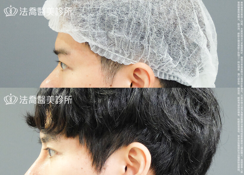 法喬醫美診所,邱浚彥,割雙眼皮