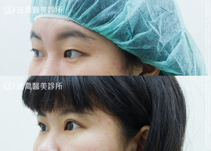 割雙眼皮