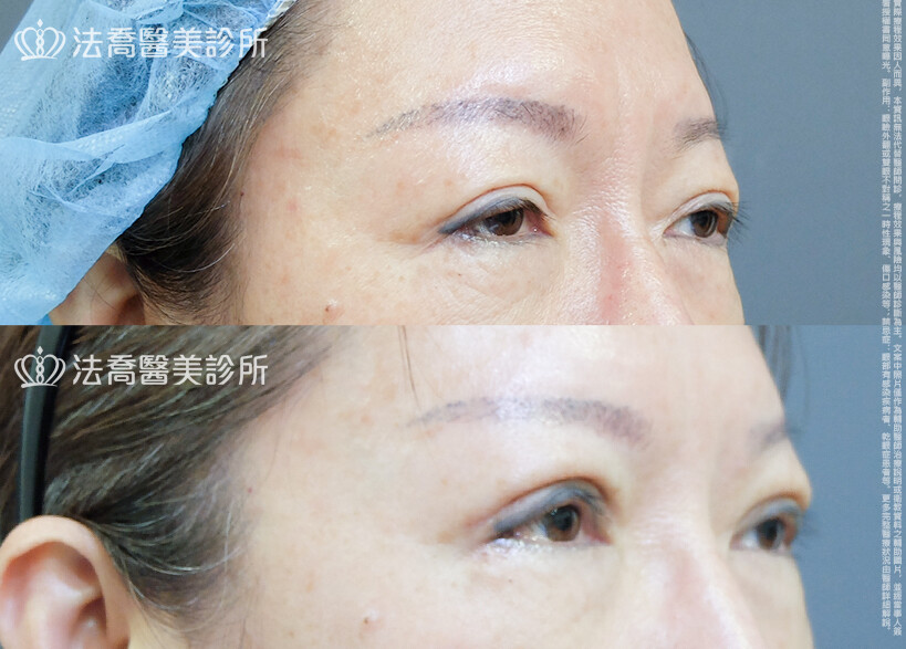 眼瞼肌提拉術&nbsp;