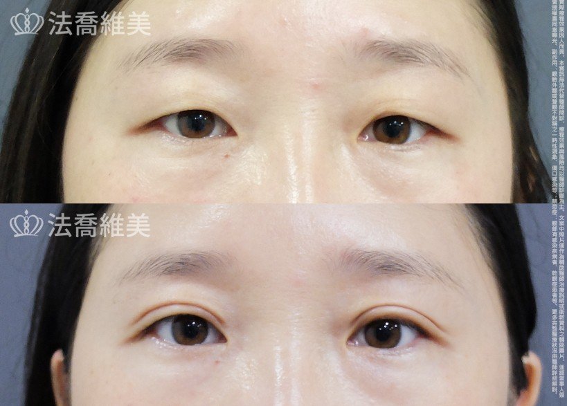 割雙眼皮