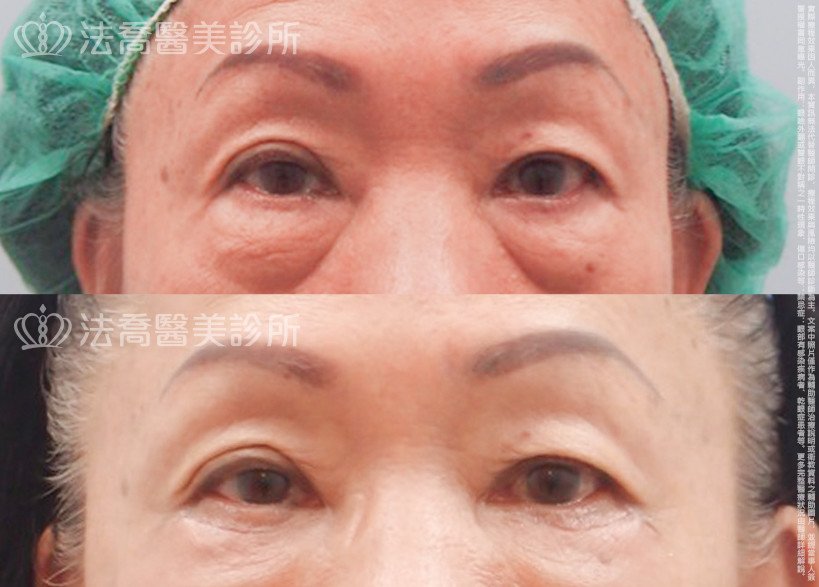 法喬醫美診所,邱浚彥醫師,眼袋內開