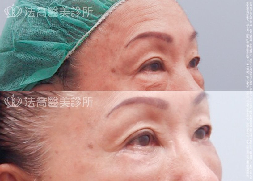法喬醫美診所,邱浚彥醫師,眼袋內開