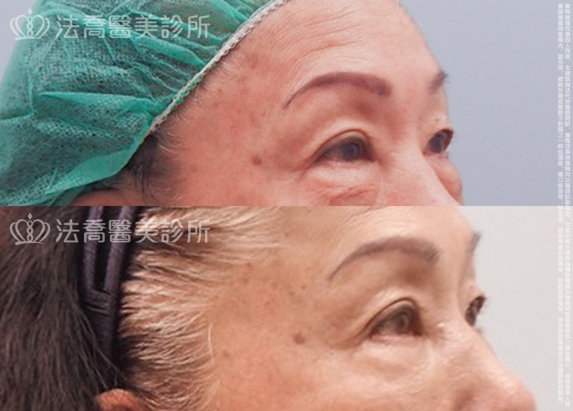 法喬醫美診所,邱浚彥醫師,眼袋內開