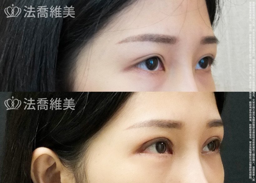 法喬醫美診所,邱浚彥,割雙眼皮,眼瞼肌提拉術,開眼頭,開眼尾