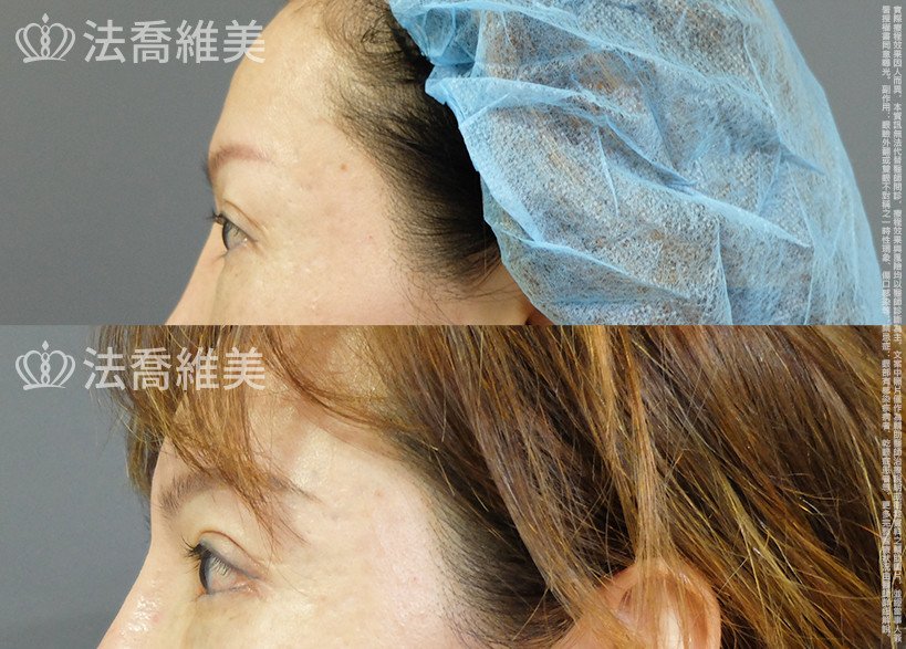 法喬醫美診所,邱浚彥,眼袋內開