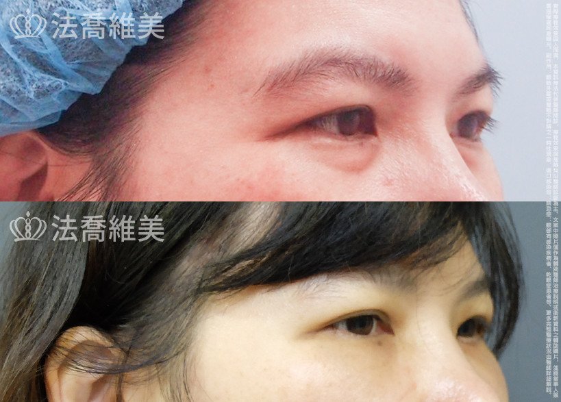 法喬醫美診所,邱浚彥,割雙眼皮