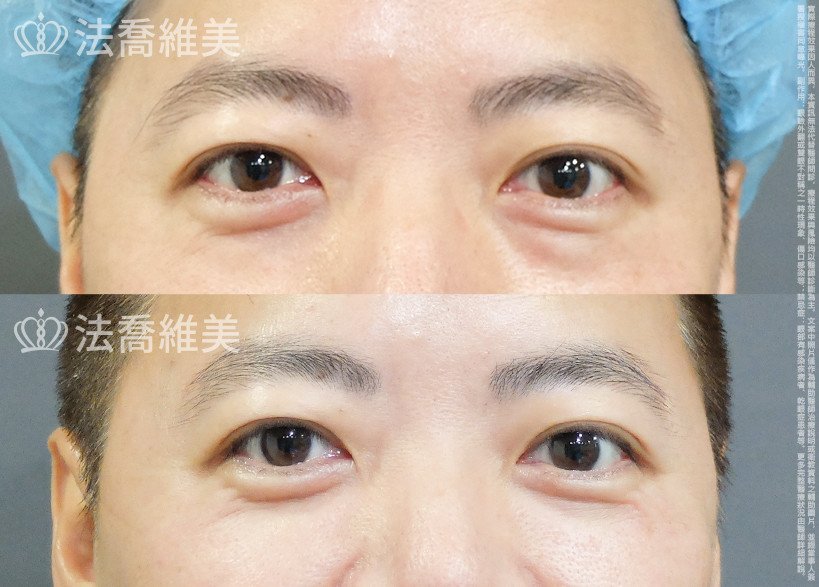法喬醫美診所 邱浚彥醫師,眼袋內開