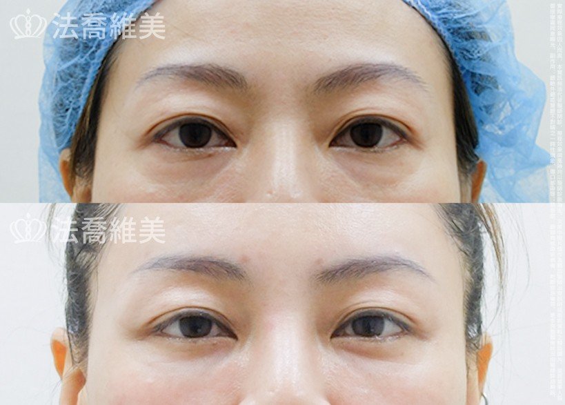 法喬醫美診所 邱浚彥醫師,眼袋內開