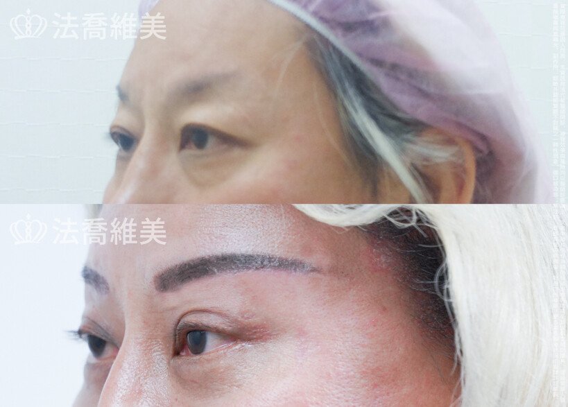 法喬醫美診所 邱浚彥醫師,眼袋內開