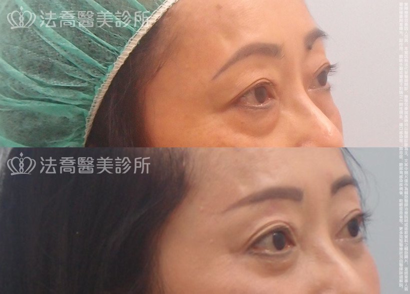 法喬醫美診所,邱浚彥,眼袋外開,切眉