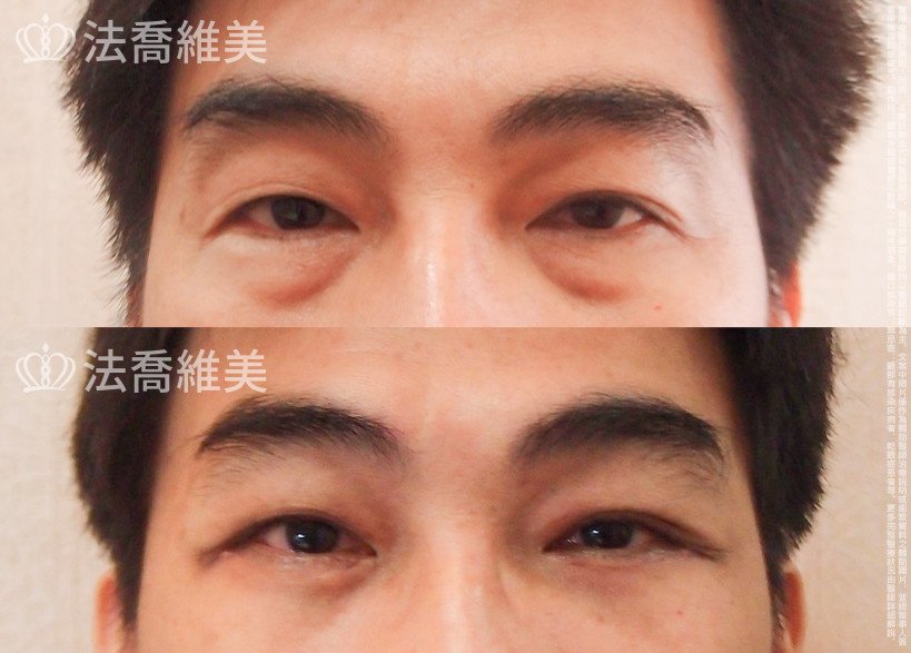 法喬醫美診所,邱浚彥醫師,眼袋外開
