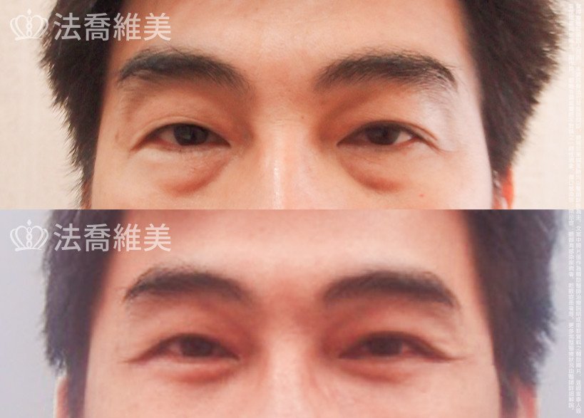 法喬醫美診所,邱浚彥醫師,眼袋外開
