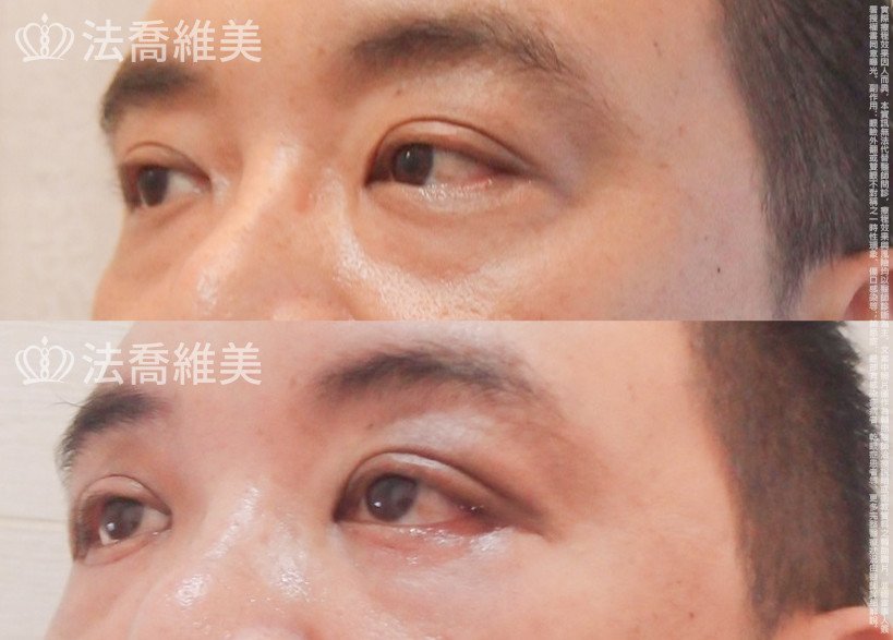 法喬醫美診所,邱浚彥醫師,眼袋外開