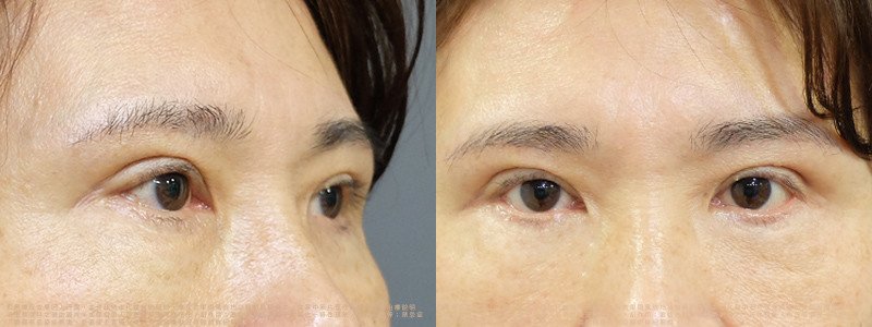 邱浚彥醫師眼袋案例_切眉+眼袋外開脂肪移位