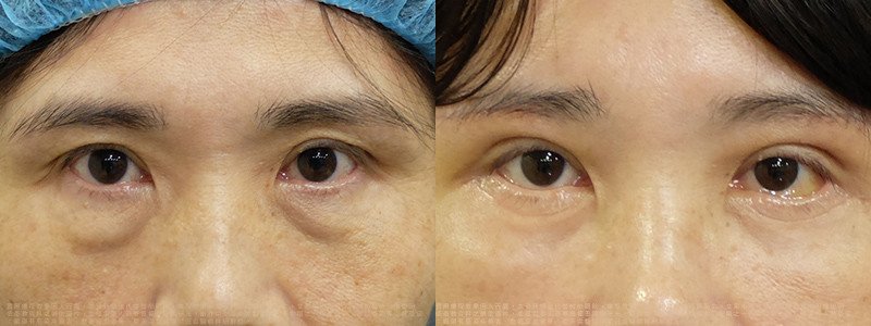 邱浚彥_切眉+眼袋外開脂肪位移