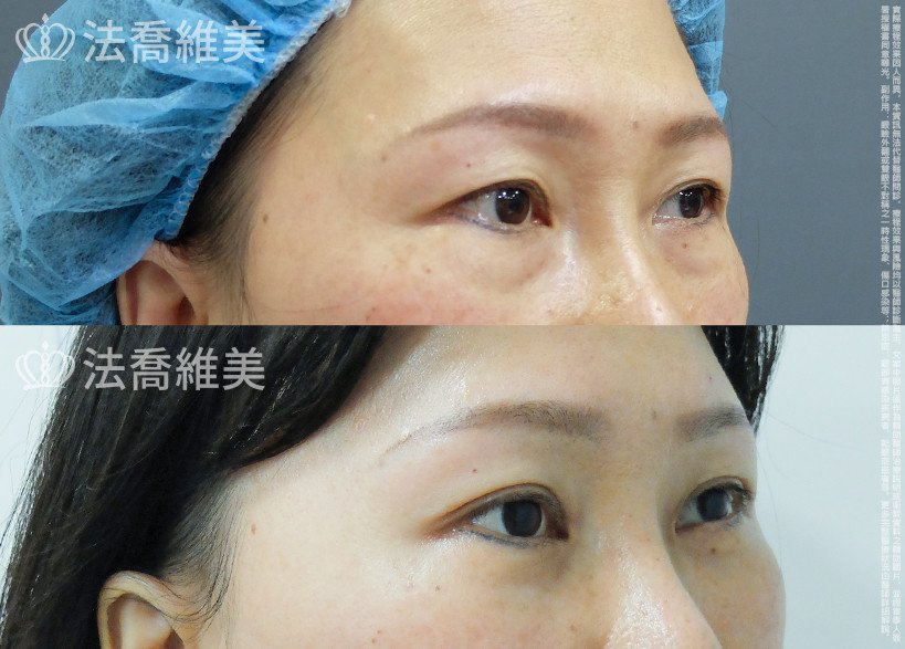 法喬醫美診所 邱浚彥醫師,縫雙眼皮