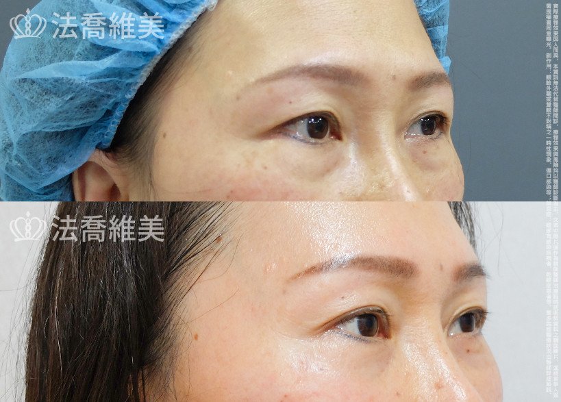 法喬醫美診所 邱浚彥醫師,縫雙眼皮