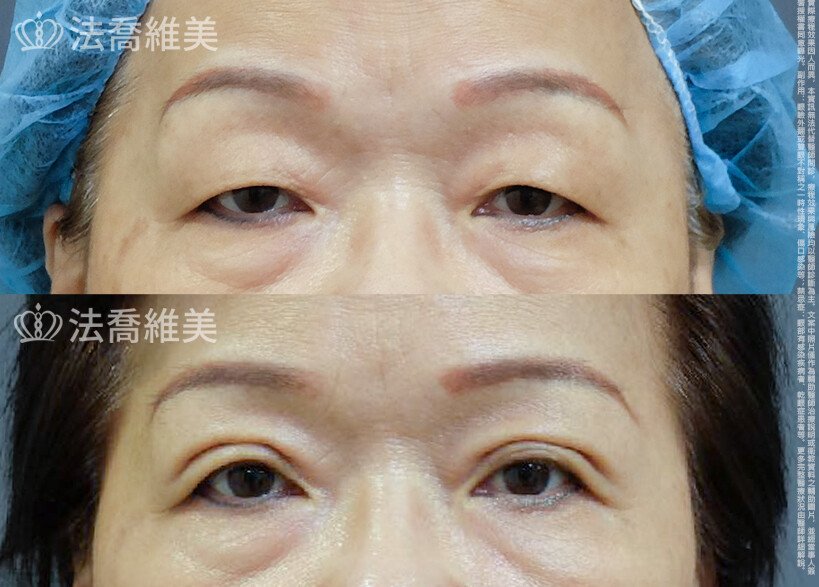 法喬醫美診所 邱浚彥醫師,縫雙眼皮