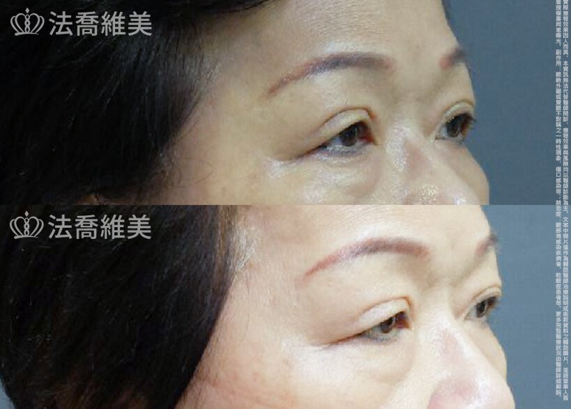 法喬醫美診所 邱浚彥醫師,縫雙眼皮