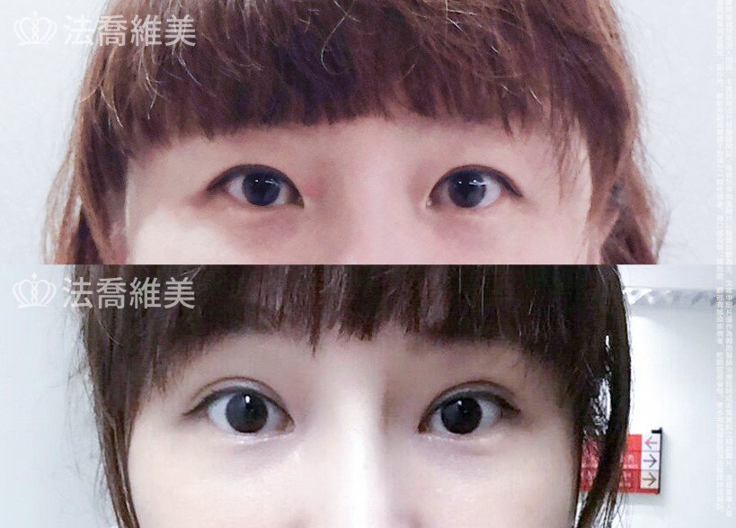 縫雙眼皮