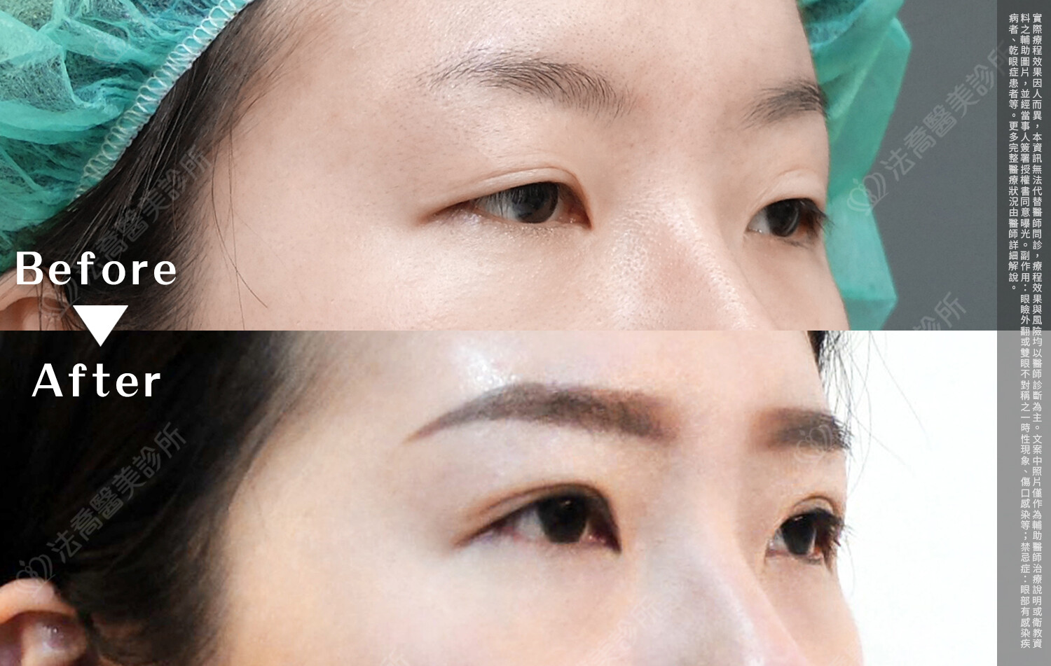 法喬醫美診所,邱浚彥,自體脂肪豐臉,割雙眼皮,眼窩補脂