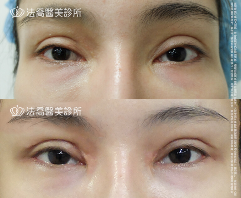 法喬醫美診所,邱浚彥,割雙眼皮,眼窩補脂