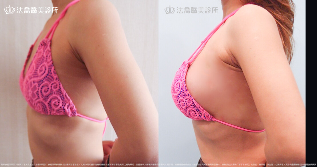 法喬醫美診所 邱浚彥醫師,複合式果凍矽膠隆乳