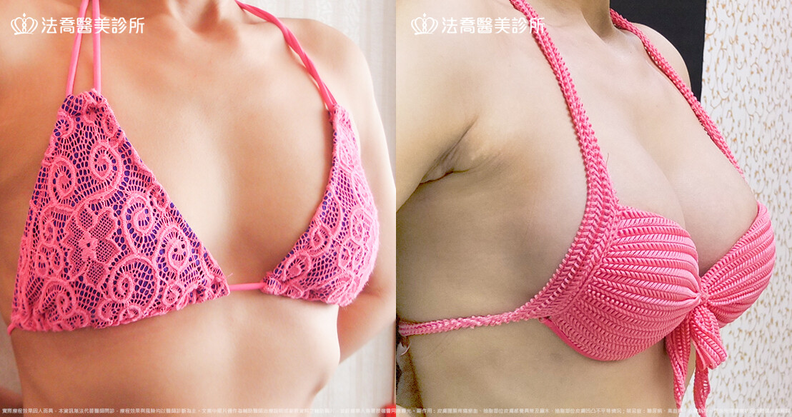 法喬醫美診所 邱浚彥醫師,複合式果凍矽膠隆乳