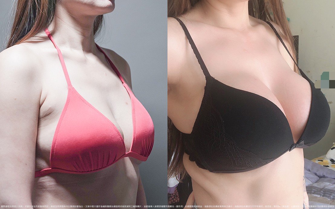 法喬醫美診所,邱浚彥,圓盤果凍矽膠隆乳