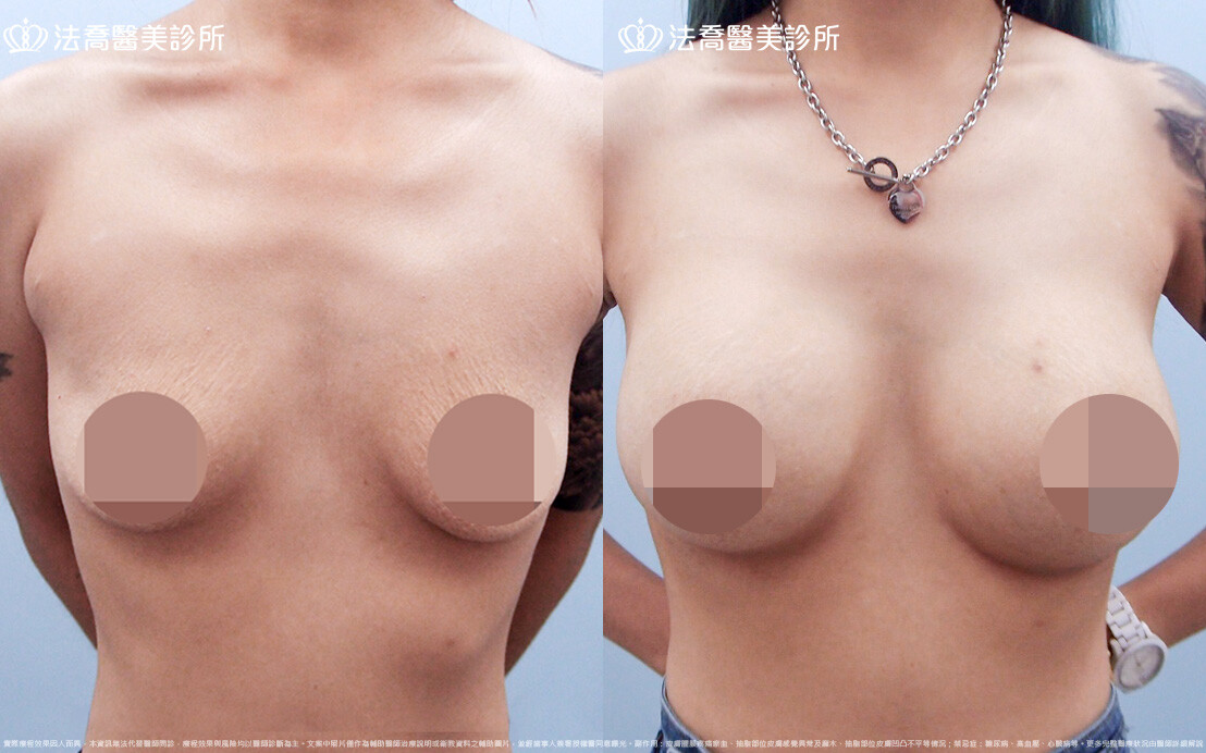 法喬醫美診所,邱浚彥,圓盤果凍矽膠隆乳